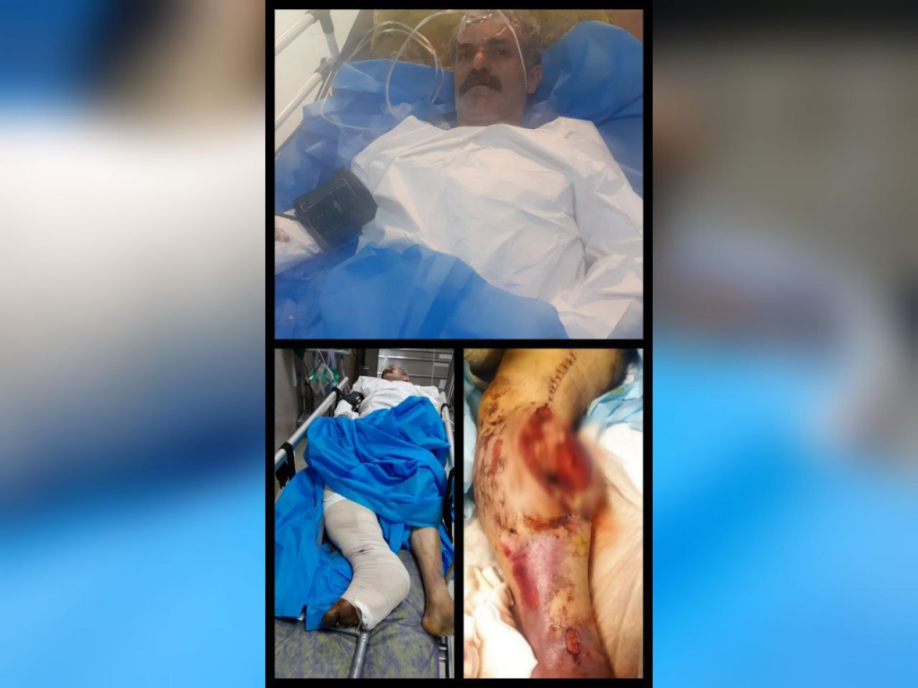 قطع پای کولبر اهل شهر جوانرود پس از انتقال به مراکز درمانی شهر تهران